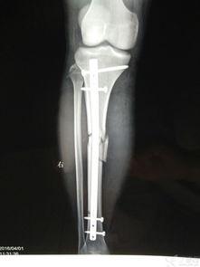 髓内钉视频,髓内钉手术操作与效果解析